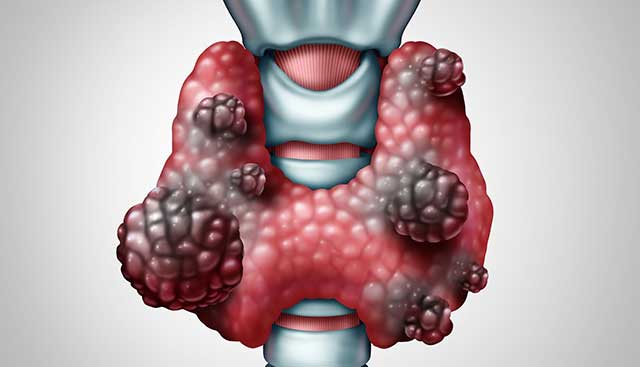 ilustrasi nodul kelenjar tiroid dan kanker